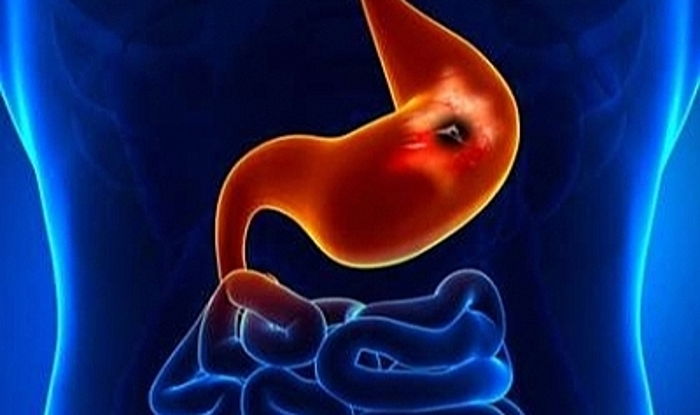 Ülserler ve Gastroenteroloji Uzmanı Uyarıyor