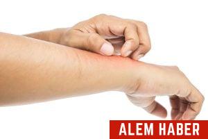 Kırım Kongo Kanamalı Ateşi Nedir?